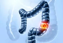 صورة سرطان القولون يتزايد بين الشباب حول العالم.. والأطباء يطلقون تحذيرات عاجلة